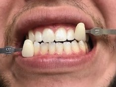 after tooth whitening