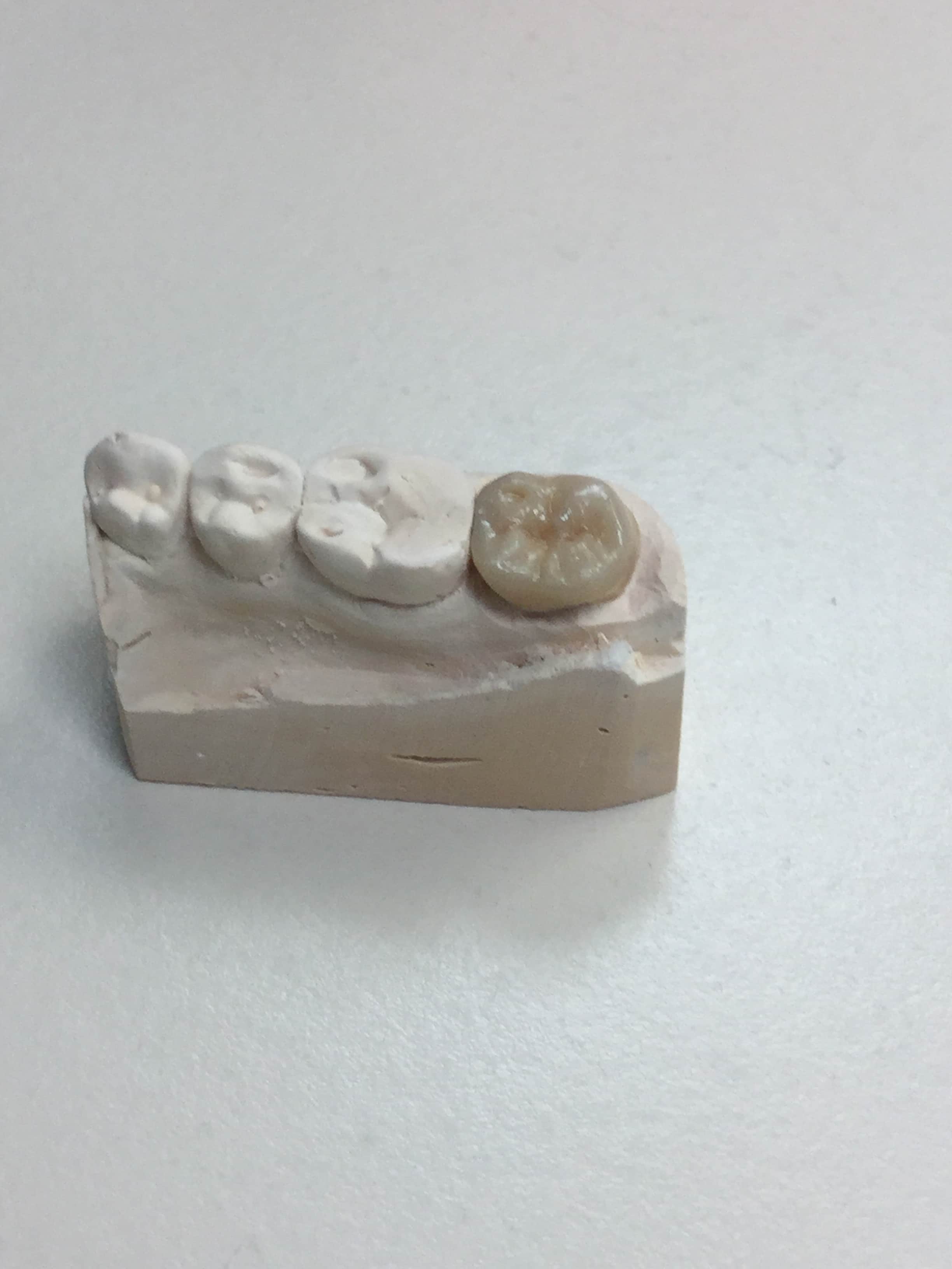 A crown covers the natural tooth.