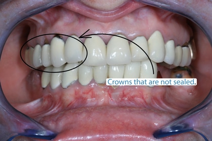 Interesting dental problems caused by overseas dentistry.