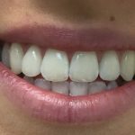 whiter teeth
