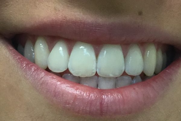 Professsional Teeth Whitening to brighten and freshen your smile