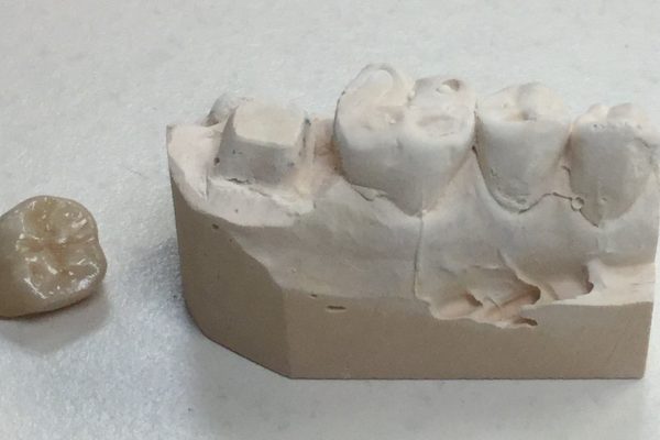 So you need a dental crown? This is how we do that to support your tooth